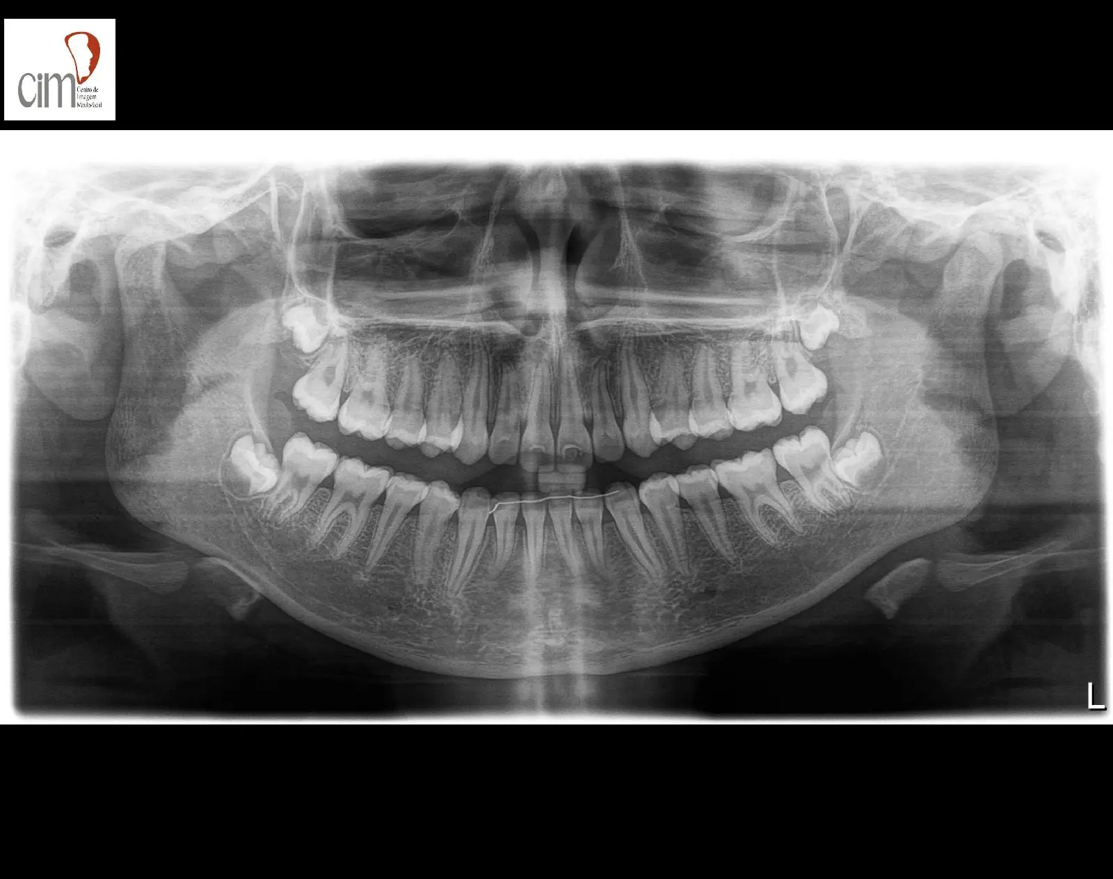 Radiografia panorâmica odontológica e telerradiografia para diagnóstico extra bucal