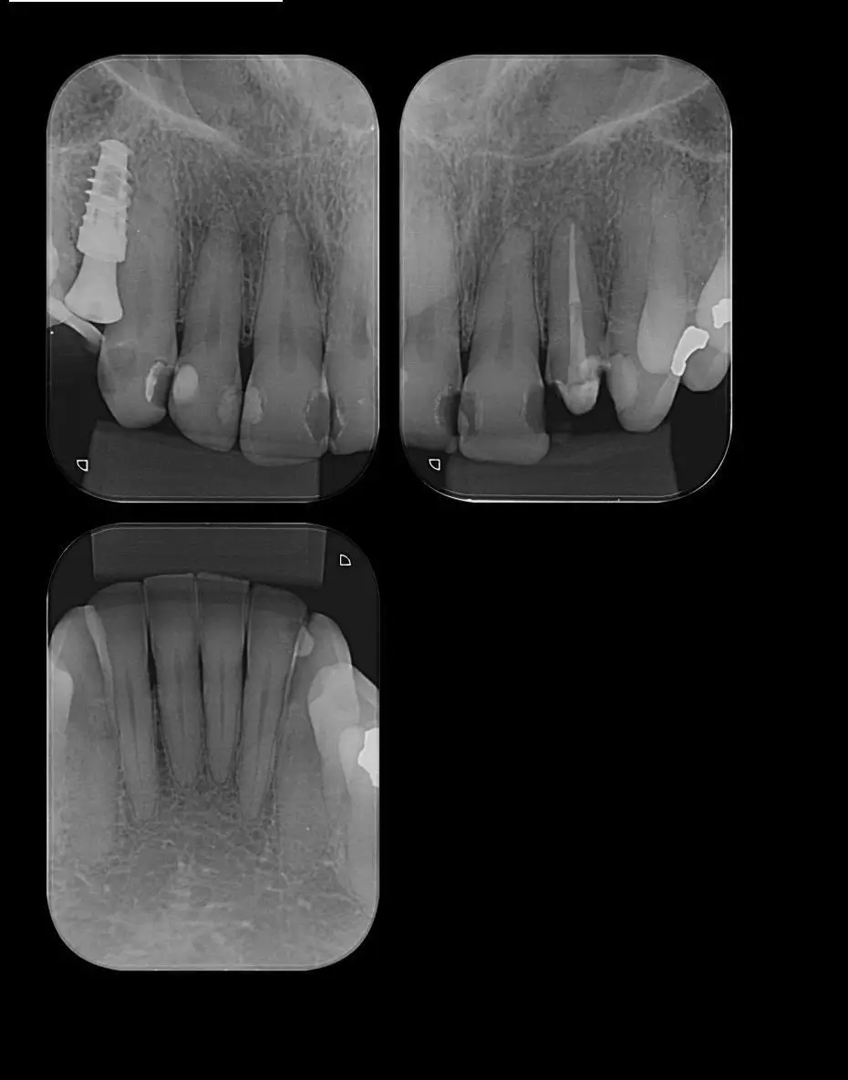 Exames intra bucais odontológicos com radiografia periapical, interproximal e técnica de localização
