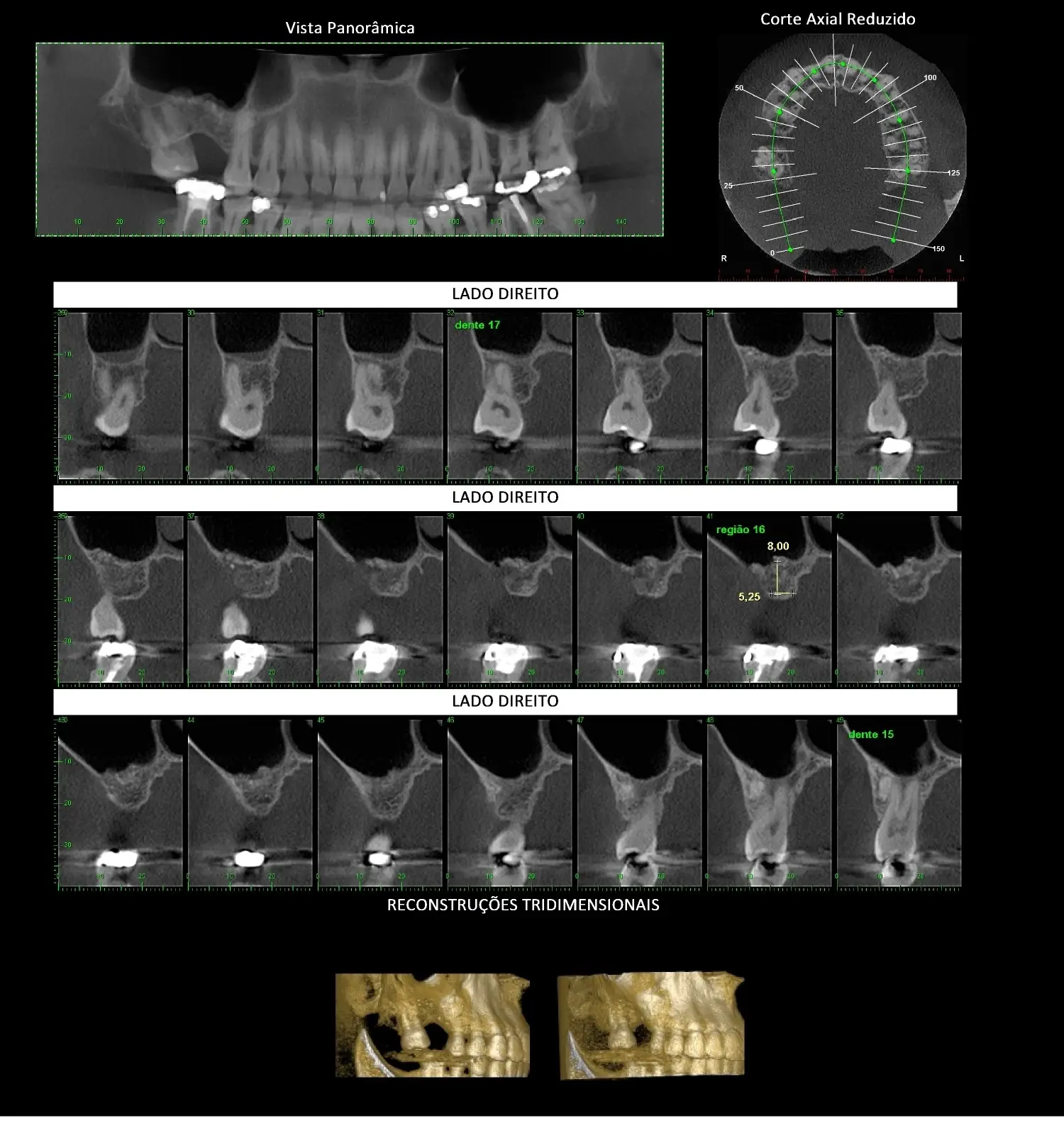 Tomografia odontológica por feixe cônico para implantes, ATM e planejamento ortodôntico